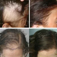 کاشت موی سر وابرو با ضمانت کتبی درتبریز