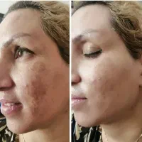 کرم  ضد لک و سفید کننده تضمینی|آرایشی، بهداشتی، درمانی|کیش, |دیوار