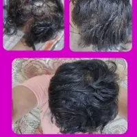 درمان ریزش مو و رویش مجدد محصول تقویتی اصل