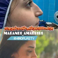 عمل بینی  سی و پنج میلیون