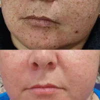 حذف دائمی،تک جلسه ای و تضمینی کک و مک و خال