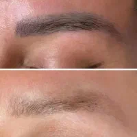 جشنواره پاک کردن تتو با لیزر کیوسوئیچ