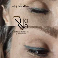 پاک کردن تتو با لیزر/ریموو ابرو/کربن تراپی(پزشک)|خدمات آرایشگری و زیبایی|مشهد, فردوسی|دیوار