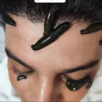 اعمال یداوی،حجامت،زالودرمانی، بادکش