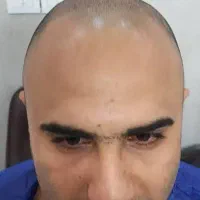 کاشت مو / ریش|خدمات آرایشگری و زیبایی|خرمآباد, |دیوار