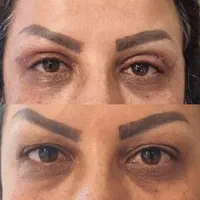 عمل(افتادگی پلک بالا و پایین )عمل زیبایی( گوش)|خدمات آرایشگری و زیبایی|فسا, |دیوار