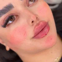 تزریق ژل وبوتاکس|خدمات آرایشگری و زیبایی|جوانرود, |دیوار