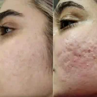 کرم ضدجوش عامل زیباییت/خرید درب خانه