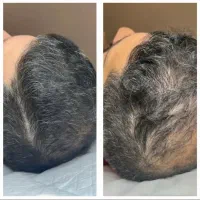 خواهان مدل برای prp مو و صورت|خدمات آرایشگری و زیبایی|سنندج, |دیوار