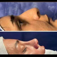 لیپو - ابدو- مامو پلاستی-عمل بینی -پروتز و