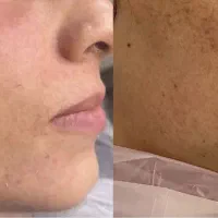 مدل برای درمان لک و اکنه(جوش) و اسکار وتیرگی بدن|خدمات آرایشگری و زیبایی|کاشان, فاز ۱ ناجی آباد|دیوار