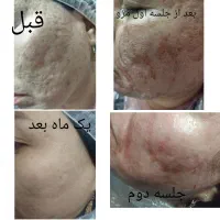 پلکسر پلاسما خالبرداری مزونیدلینگ مزو آموزش|خدمات آرایشگری و زیبایی|زاهدان, |دیوار