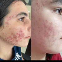 بدون برگشت و دائمی درمان بیماری پوستی|خدمات آرایشگری و زیبایی|گنبد کاووس, |دیوار