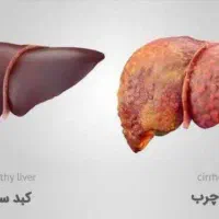 بهبود وپاکسازی کبد با مشاوره رایگان