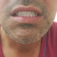 ساخت عنواع دندان مصنوعی ایرانی وخارجی|خدمات آرایشگری و زیبایی|آشخانه, |دیوار