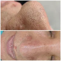 فشیال وپاکسازی صورت