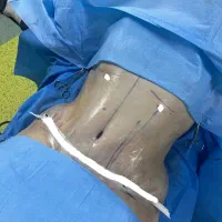 پیکرتراشی لیپوماتیک ۴۵ م آبدو مامو پروتز لیفت لیپو