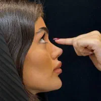 جشنواره جراحی بینی