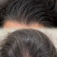 میکرواسکالپ سر|خدمات آرایشگری و زیبایی|جهرم, |دیوار