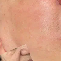 لیزر روشن کننده و رفع تیرگی کربن تراپی
