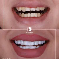 کامپوزیت/لمینت/دندانپزشکی|خدمات آرایشگری و زیبایی|مشهد, کوثر|دیوار