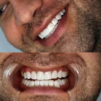 دندانپزشکی کامپوزیت(دندان مصنوعی) (اقساط ۱۰ ماه)|خدمات آرایشگری و زیبایی|قم, حکمت شمالی|دیوار