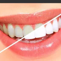 جرمگیری تخفیف ویژه دندانپزشکی