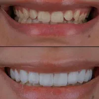 طرح لبخند*بی‌نظیرترین کیفیت*کمترین قیمت دندانپزشکی|خدمات آرایشگری و زیبایی|شیراز, ملاصدرا|دیوار