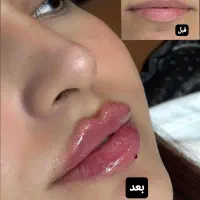 ژل /بوتاکس/آنزیم