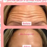 جشنواره ژل و بوتاکس و مزوژل|خدمات آرایشگری و زیبایی|تهران, ظفر|دیوار