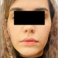 مشاوره تلفنی رایگان با پزشک زیبایی (بوتاکس،فیلرو.)