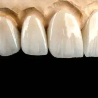 آموزش دندانسازی پروتز ثابت