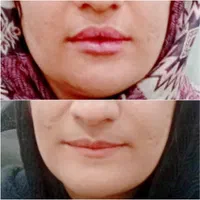 تزریق ژل لب.گونه.چانه.زاویه سازی فک.آنزیم بینی|خدمات آرایشگری و زیبایی|اردکان, |دیوار