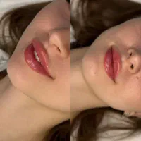 ژل و بوتاکس
