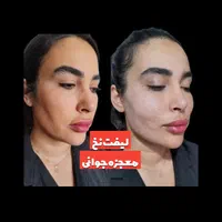 لیفت نخ صورت(بدون جراحی) در کلینیک باتخفیف50درصدی