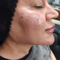 فیلر/ژل/بوتاکس ،بدون درد و کبودی|خدمات آرایشگری و زیبایی|شیراز, مسلم|دیوار