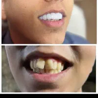 دندانپزشکی عصب کشی ،روکش،ایمپلنت،کامپوزیت|خدمات آرایشگری و زیبایی|بروجرد, |دیوار