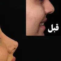 فرم دهی بینی با چسب لیفت آگهی رو با دقت بخونید