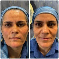 جشنواره لیفت تخصصی صورت با نخ و کانتورینگ|خدمات آرایشگری و زیبایی|بروجرد, |دیوار