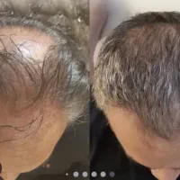 اکسونیک .. تونیک مجدد رویش و ریزش موی سر