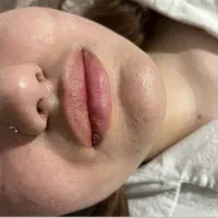 فیلر(ژل)و بوتاکس|خدمات آرایشگری و زیبایی|سهند, |دیوار