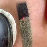 پیلینگ کربن بدن و صورت روشن سازی ریموو تتو|خدمات زیبایی و سلامت|کرج, گلشهر|دیوار