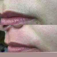 لیزرفول بادی و روشنکننده نواحی تیره ۲۹۰ ژل وبوتاکس|خدمات آرایشگری و زیبایی|قم, حاج زینل|دیوار