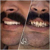 ایمپلنت و زیبایی دندان اقساط ۱۲ ماهه اکو دنتال|خدمات آرایشگری و زیبایی|تهران, خانی آباد نو شمالی|دیوار