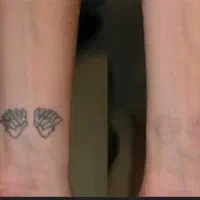 ریموو تخصصی لیزر کیوسویچ