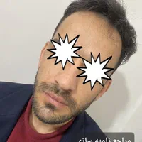 ژل وبوتاکس بلک فرایدی404(اقساط)(توسط پزشک)|خدمات آرایشگری و زیبایی|خرمآباد, |دیوار