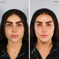 تزریق ژل و بوتاکس و مادلینگ عربی|خدمات آرایشگری و زیبایی|کرمانشاه, |دیوار