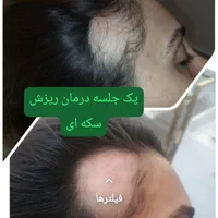 جشنواره اگزوزوم، فیلر بادی نخ،ژل،پی ارپی|خدمات آرایشگری و زیبایی|تهران, سعادت‌آباد|دیوار