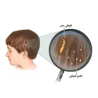 درمان کامل شپش تظمینی|آرایشی، بهداشتی، درمانی|پارس‌آباد, |دیوار