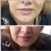 تزریق تخصصی فیلر،بوتاکس،مزو وآنزیم درمطب|خدمات آرایشگری و زیبایی|کرمانشاه, |دیوار